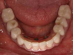 DentalImplants4