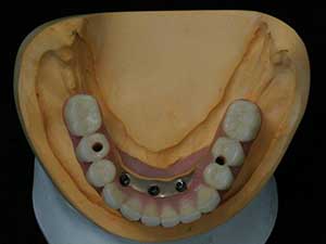 DentalImplants3
